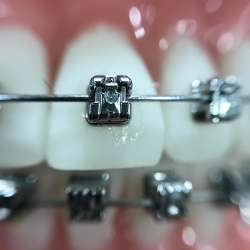 Orthodontic Wax